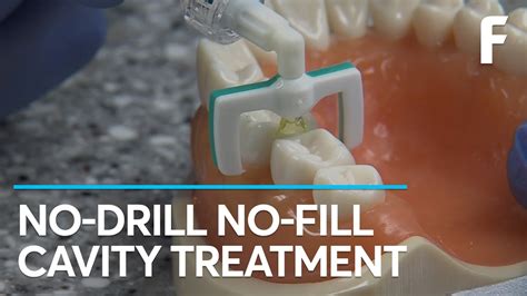 How to Treat CavitiesHealth and Home Remedies YouTube