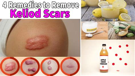Diy Keloid Removal