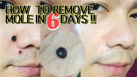 DIY mole removal