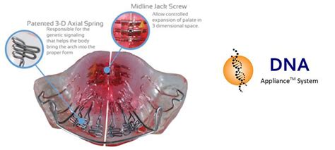 Dna Appliance Vs Braces
