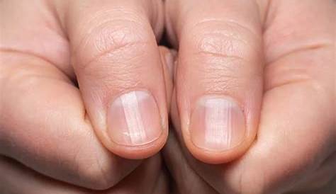 What ridges in your nails really mean and when it's time to go