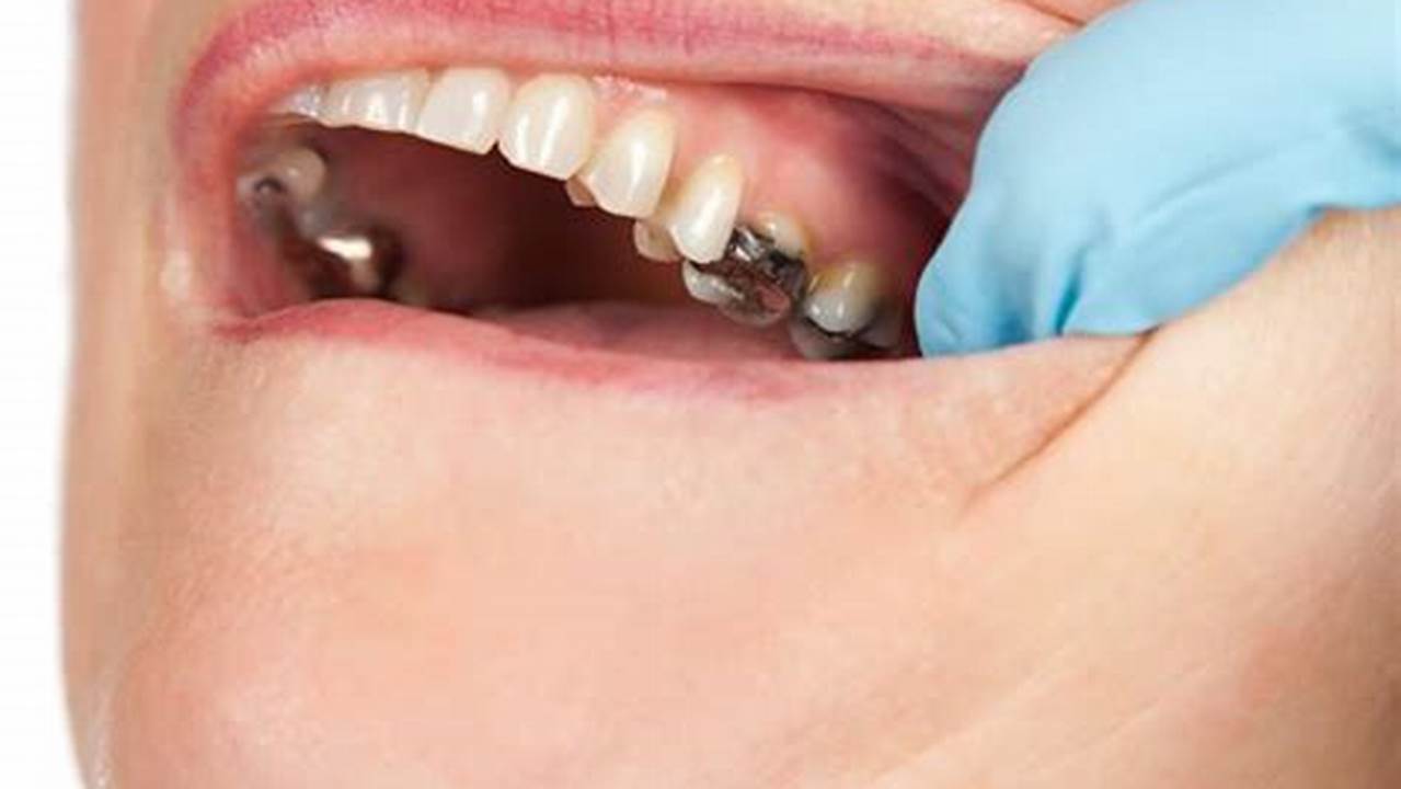 Dentistry Uncovered: The Truth About Mercury Fillings