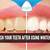do you brush your teeth after using whitening strips