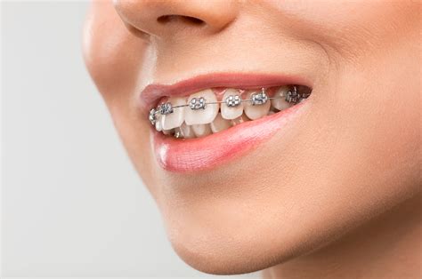 Dental Braces Types, Procedure, Benefits & Costs
