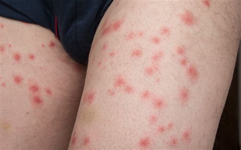 Do Bed Bug Rashes Spread