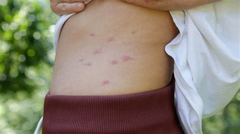 Do Bed Bugs Bite And Itch