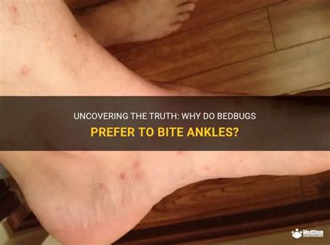 Do Bed Bugs Bite Your Ankles