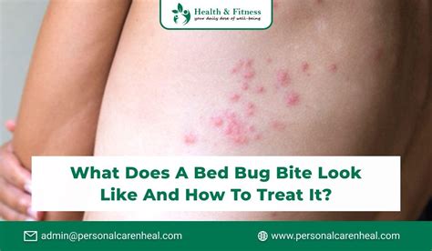 Do Bed Bugs Bites Look Like Pimples