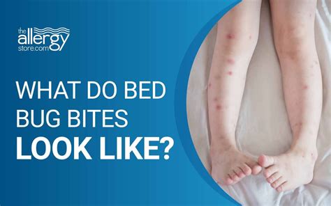 Do Bed Bugs Bites Make You Sick