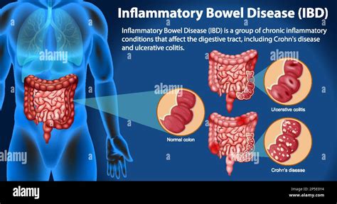 Do Blood Tests Show Bowel Problems