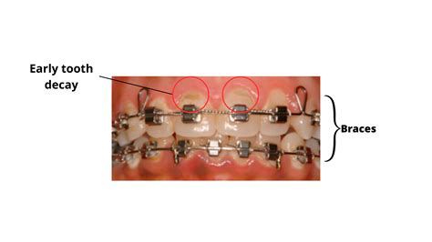 Do Braces Damage Enamel