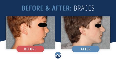 Do Braces Fix Weak Chin