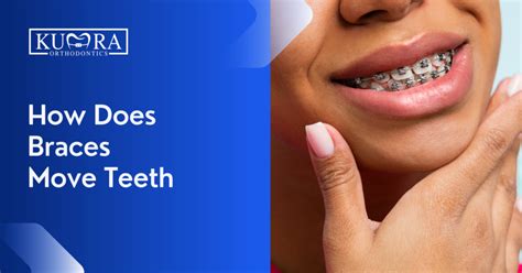 Do Braces Move Teeth Everyday