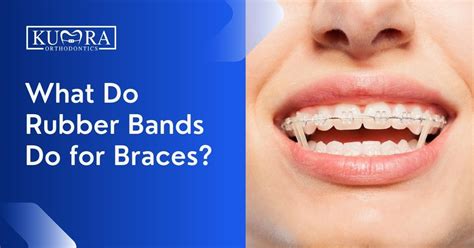 Do Braces Need Rubber Bands