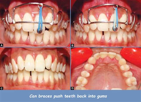 Do Braces Push Teeth Back