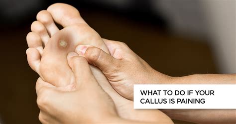 Do Calluses Go Away on Their Own? Here's What You Need to Know