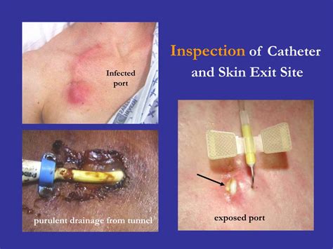 do catheters cause infection