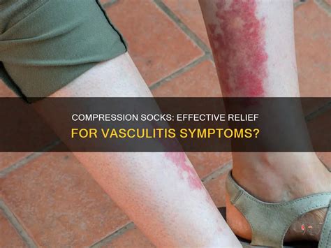 Do Compression Socks Help Golfer's Vasculitis