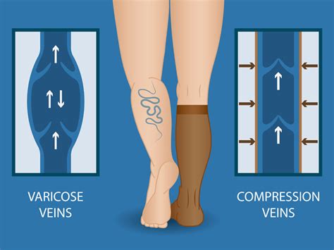 Do Compression Socks Help With Varicose