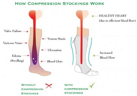 Do Compression Socks Work For Circulation