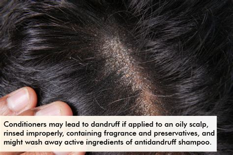 Do Conditioners Cause Dandruff
