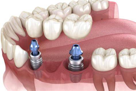 Do Dental Implants Need Crowns? The Definitive Guide to Implant Restoration
