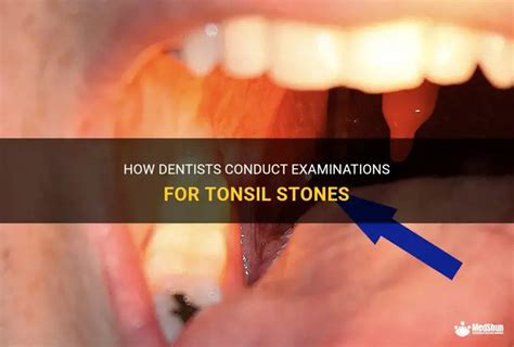 Worried About Tonsil Stones? Try These Tests To See If You Have Tonsil
