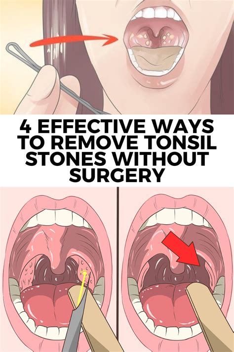 Tonsil stone removal YouTube