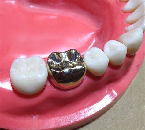 WHAT IS THE VALUE OF YOUR DENTAL GOLD? by Stewart Gillham Medium