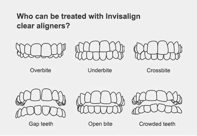 Brackets o Invisalign ¿cuál es la mejor opción? Hit Dental