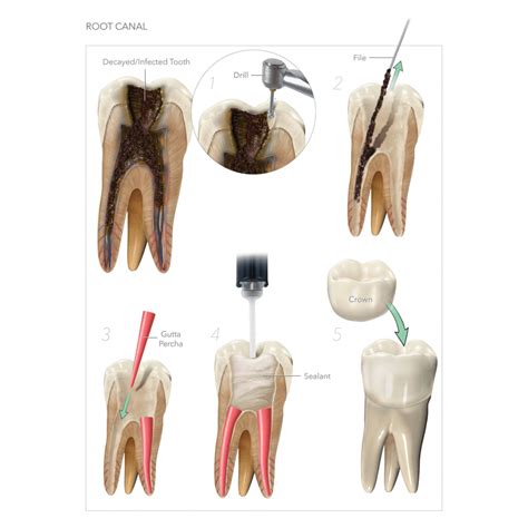 How Long Does a Root Canal Take Nashville, TN Gulch Dental Studio