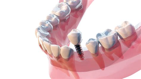 Tooth Extraction When Will Dentists Pull Teeth? Dr. Varley