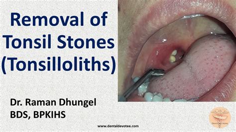 Worried About Tonsil Stones? Try These Tests To See If You Have Tonsil