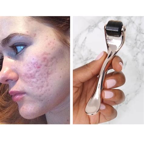 Do Derma Rollers Really Work For Acne Scars