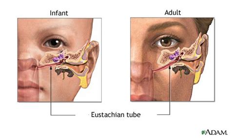 Do Ear Drops Help Eustachian Tube Dysfunction