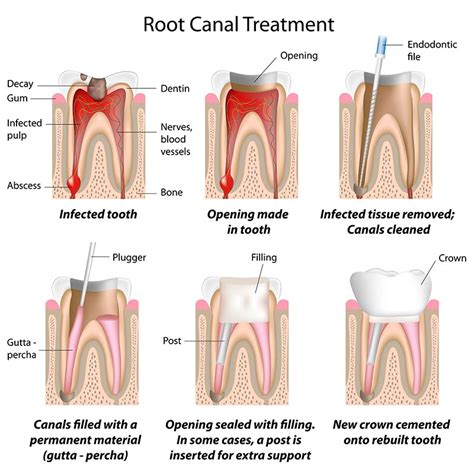 Do Endodontists Do Root Canals