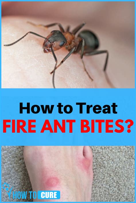 do fire ant bites itch