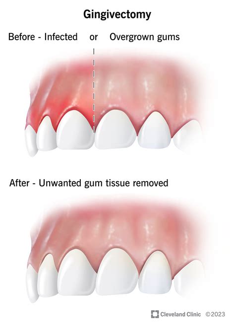 Do Gums Grow Back After Gingivectomy