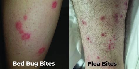 Do I Have Bed Bug Or Flea Bites