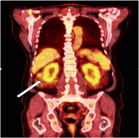 do kidneys light up on pet scan