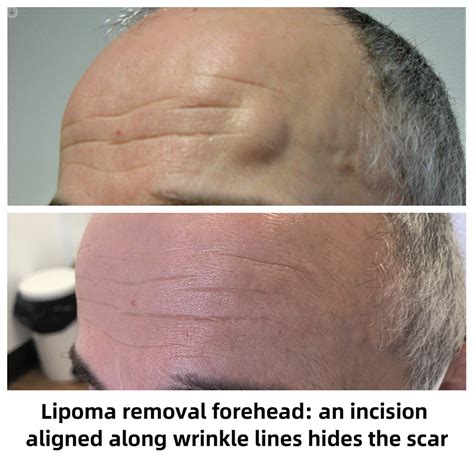 Do Lipomas Go Away on Their Own Naturally?