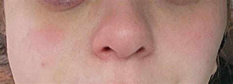 do malar rashes go away
