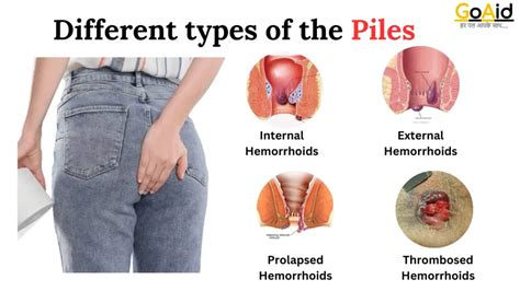 Do Piles Smell: Surprising Insights