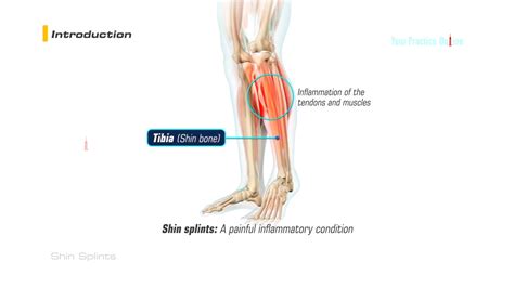 Do Shin Splints Affect The Knee