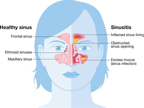 Do Sinuses Make You Sleepy