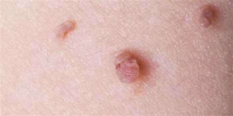 Do Skin Tags Fall Off Naturally On Their Own?