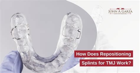Do Splints Help Tmj