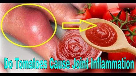 Do Tomatoes Inflame Joints