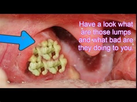 do tonsil stones cause bad breath