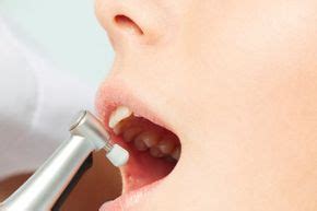 Do Tooth Polishers Work